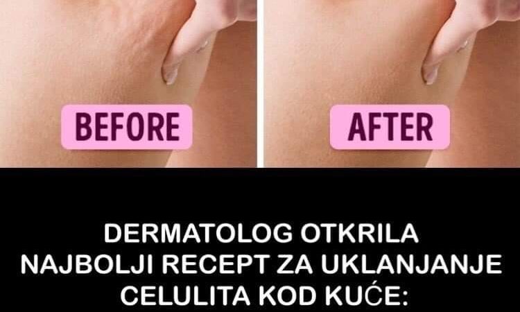 Lijek u borbi protiv celulita napravite sami kod kuće, recept otkrio čuveni dermatolog