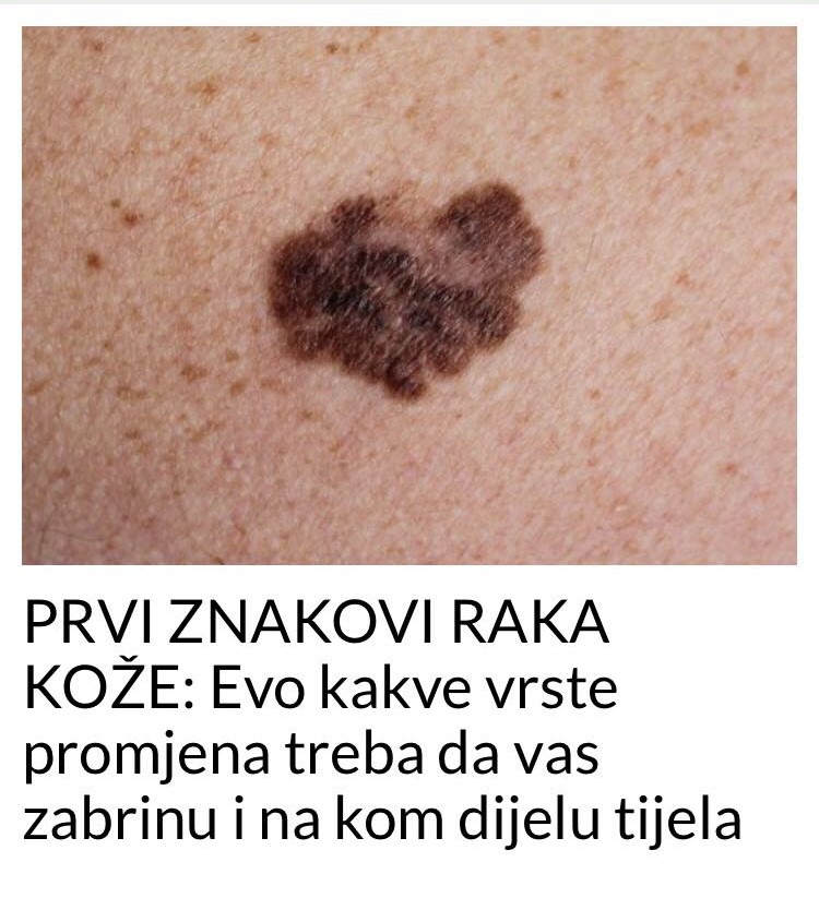 POGLEDAJTE KOJI SU TO PRVI ZNAKOVI RAKA KOŽE