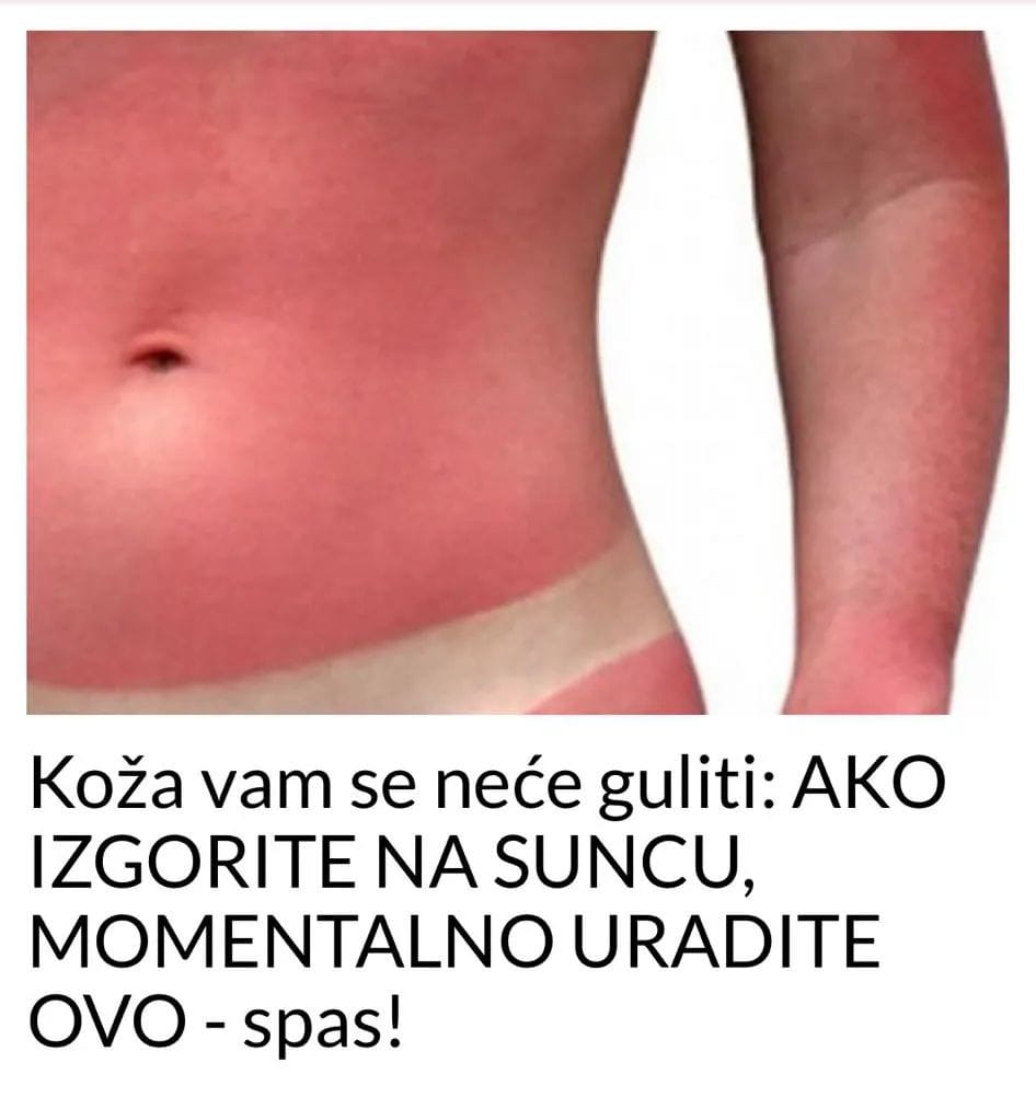 EVO STA DA URADITE KADA IZGORITE NA SUNCU