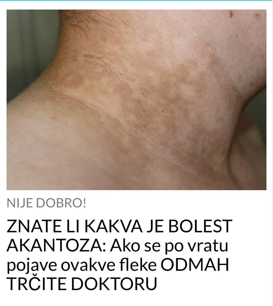 DA LI STE ČULI ZA BOLEST AKANTOZA