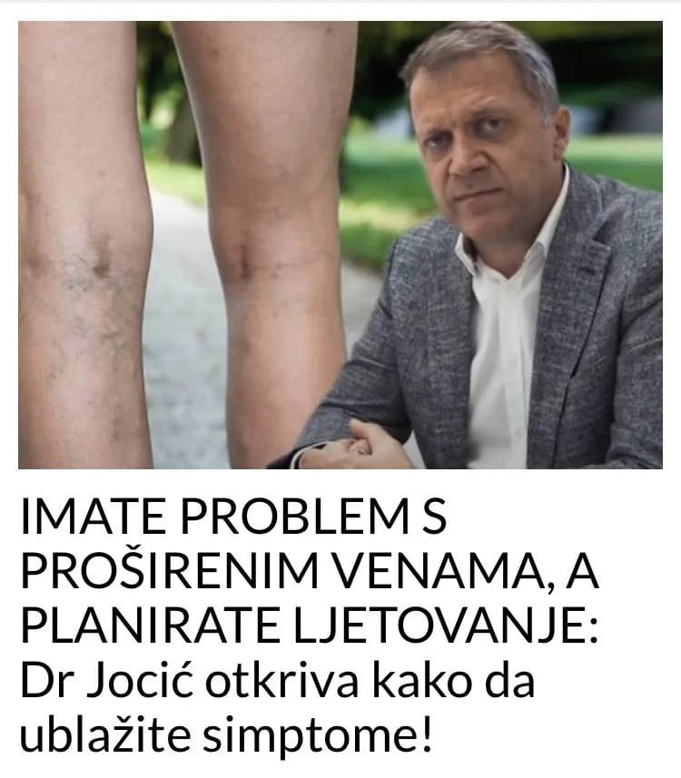 EVO KAKO UBLAŽITI SIMPTOME PROŠIRENIH VENA