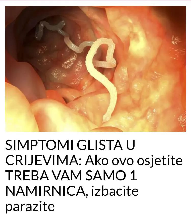 POGLEDAJTE KOJI SU TO SIMPTOMI GLISTE U CRIJEVIMA