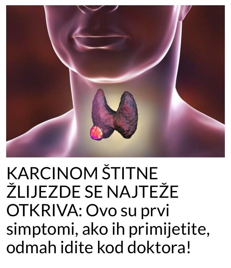 POGLEDAJTE KOJI SU SIMPTOMI KANCERA ŠTITNE ŽLIJEZDE