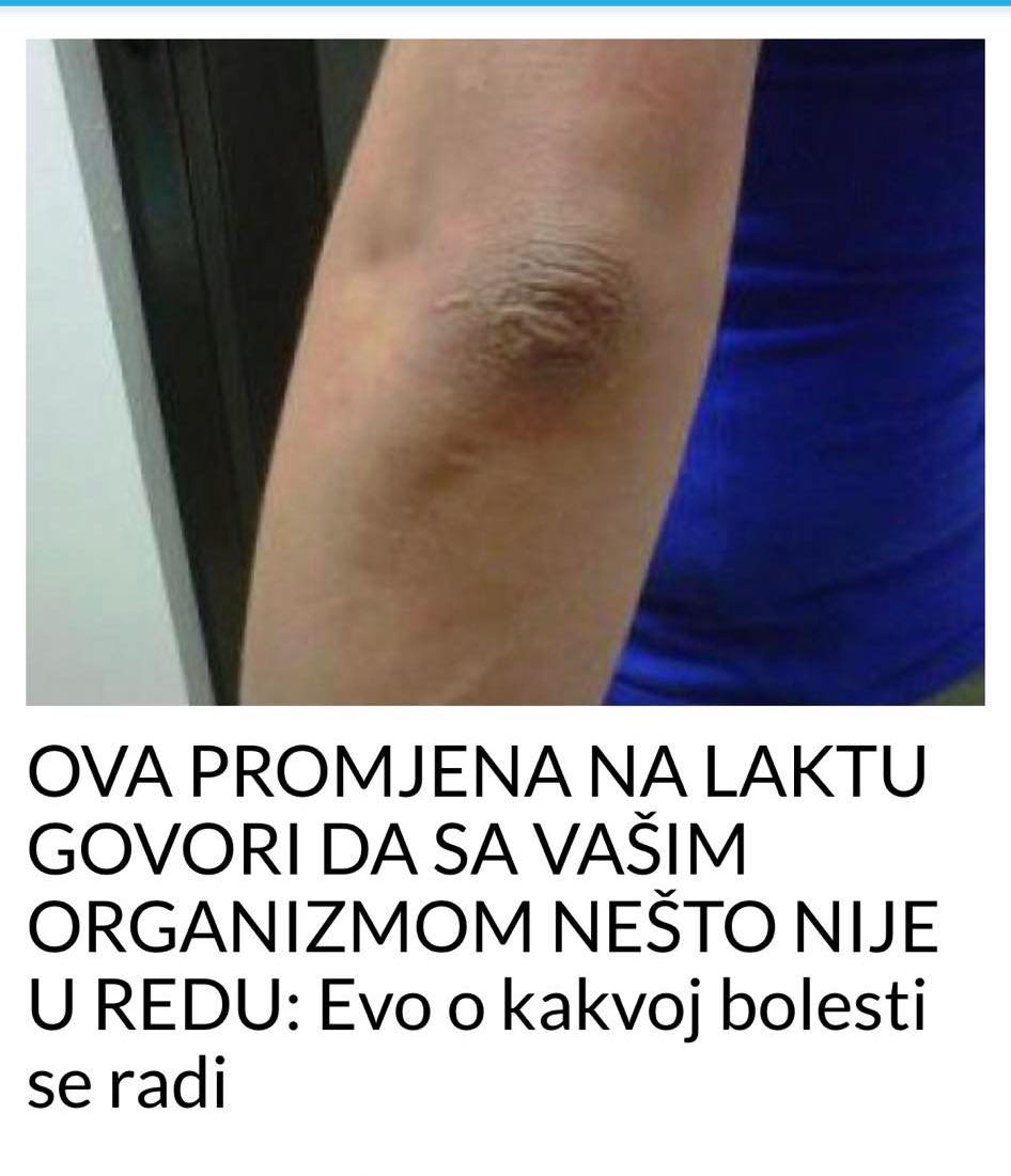 POGLEDAJTE KOJA PROMJENA NA LAKTU GOVORI DA SA VAŠIM ORGANIZMOM NEŠTO NIJE U REDU