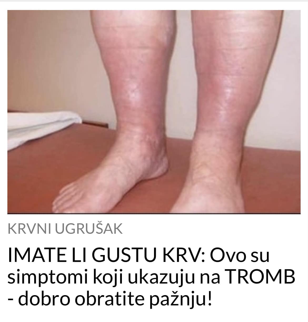 POGLEDAJTE KOJI SIMPTOMI UKAZUJU NA TO DA IMATE TROMB, PRIPAZITE