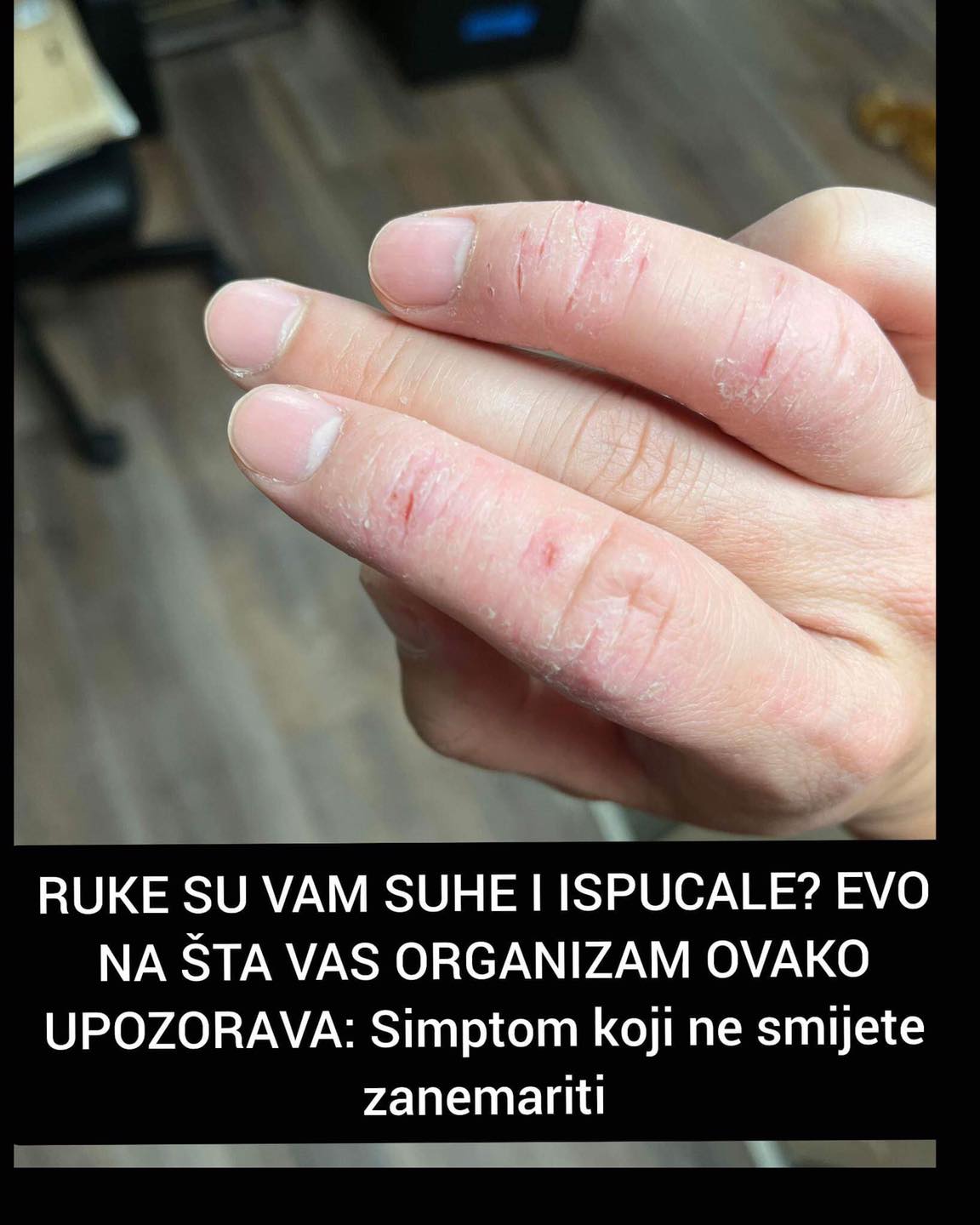 AKO SU VAM RUKE SUHE I ISPUCALE? EVO NA ŠTA VAS ORGANIZAM OVAKO UPOZORA