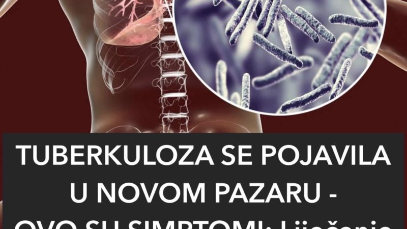TUBERKULOZA SE POJAVILA U NOVOM PAZARU-POGLEDAJTE SIMPTOME
