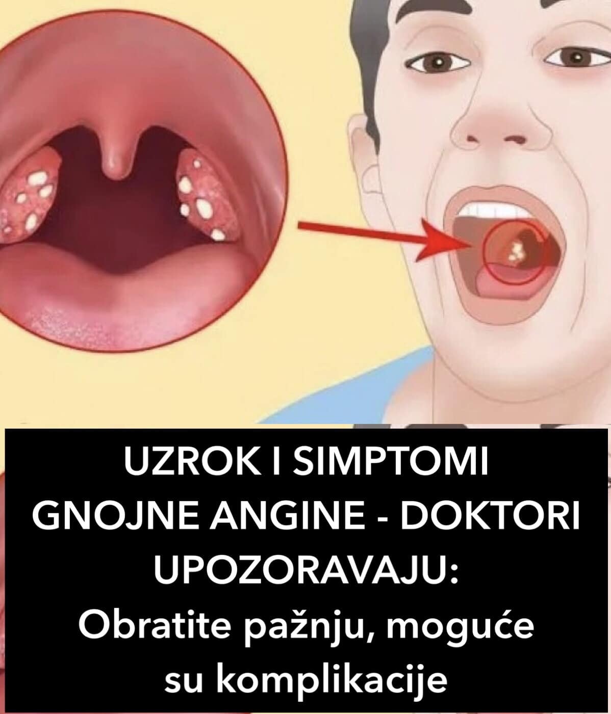 POGLEDAJTE UZROK I SIMPTOME GNOJNE ANGINE