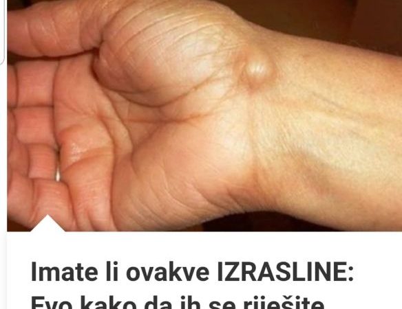 EVO KAKO DA SE RIJESITE OVIH IZRASLINA