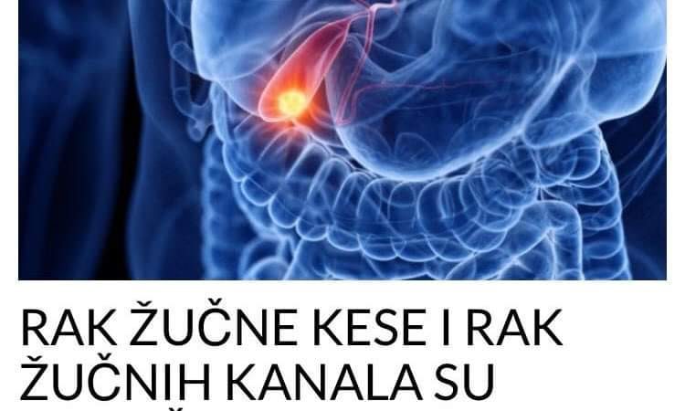 RAK ŽUČNE KESE I RAK ŽUČNIH KANALA SU RAZLIČITE BOLESTI: